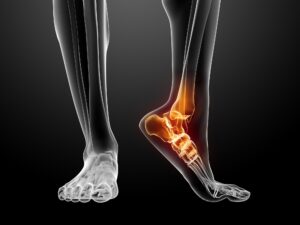dreamstime_m_18584020 x ray ankle pain