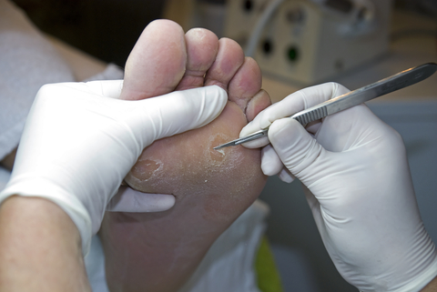 dreamstime_xs_12236775 removing hard skin on foot with scalpel