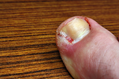 In-growing toe nail surgery - First Class Podiatry